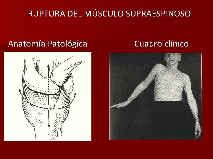 RUPTURA DEL MÚSCULO SUPRAESPINOSO Anatomía Patológica Cuadro clínico 