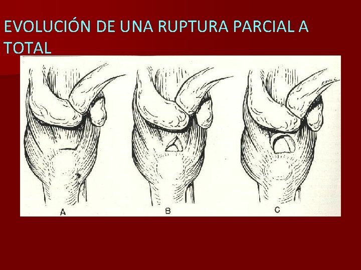 EVOLUCIÓN DE UNA RUPTURA PARCIAL A TOTAL 