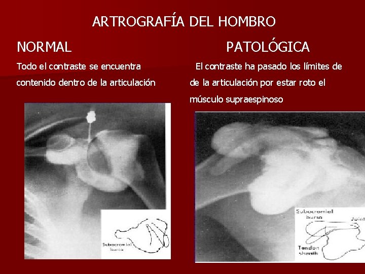 ARTROGRAFÍA DEL HOMBRO NORMAL Todo el contraste se encuentra contenido dentro de la articulación