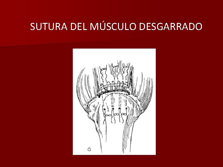 SUTURA DEL MÚSCULO DESGARRADO 