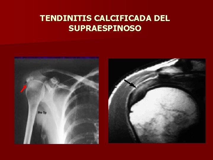 TENDINITIS CALCIFICADA DEL SUPRAESPINOSO 