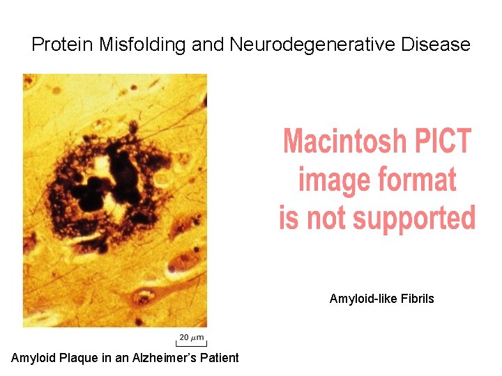 Protein Misfolding and Neurodegenerative Disease Amyloid-like Fibrils Amyloid Plaque in an Alzheimer’s Patient 