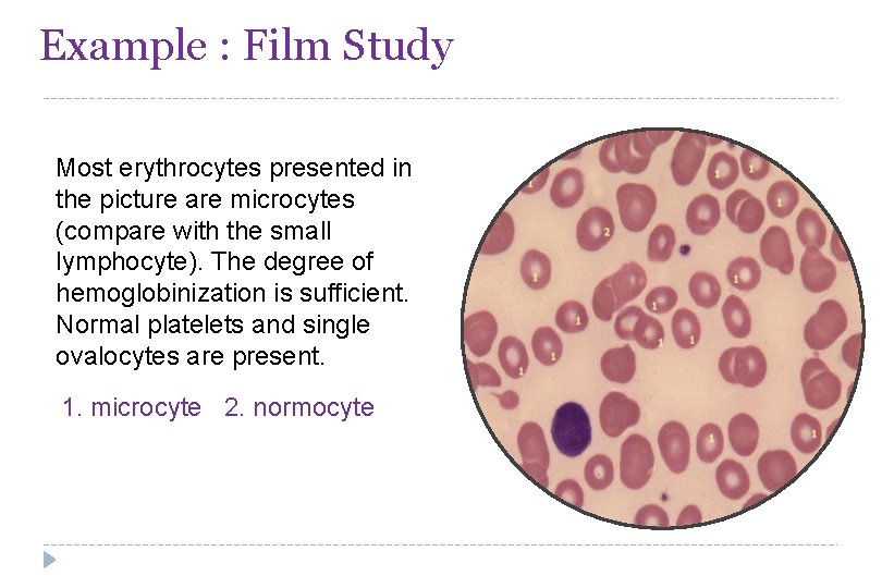 Example : Film Study Most erythrocytes presented in the picture are microcytes (compare with
