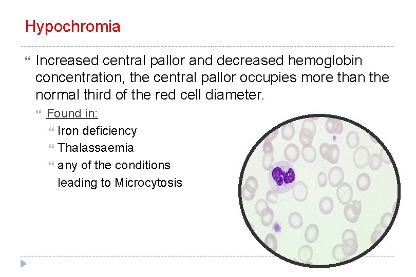 Hypochromia Increased central pallor and decreased hemoglobin concentration, the central pallor occupies more than