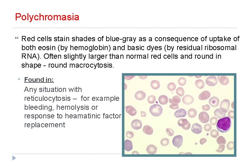 Polychromasia Red cells stain shades of blue-gray as a consequence of uptake of both