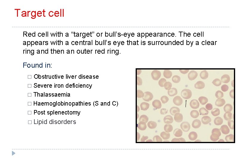 Target cell Red cell with a “target” or bull’s-eye appearance. The cell appears with