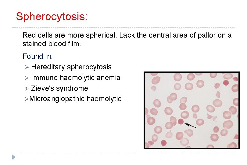 Spherocytosis: Red cells are more spherical. Lack the central area of pallor on a