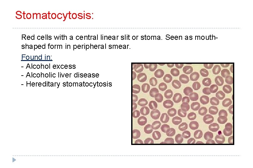 Stomatocytosis: Red cells with a central linear slit or stoma. Seen as mouthshaped form