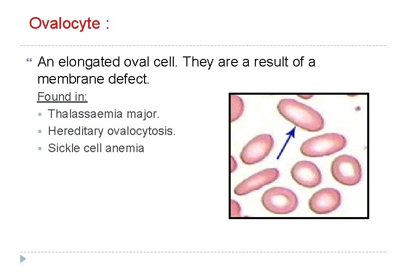 Ovalocyte : An elongated oval cell. They are a result of a membrane defect.