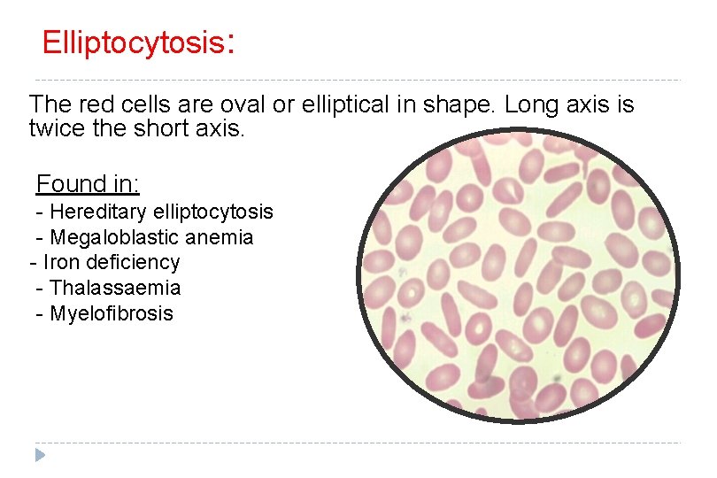 Elliptocytosis: The red cells are oval or elliptical in shape. Long axis is twice