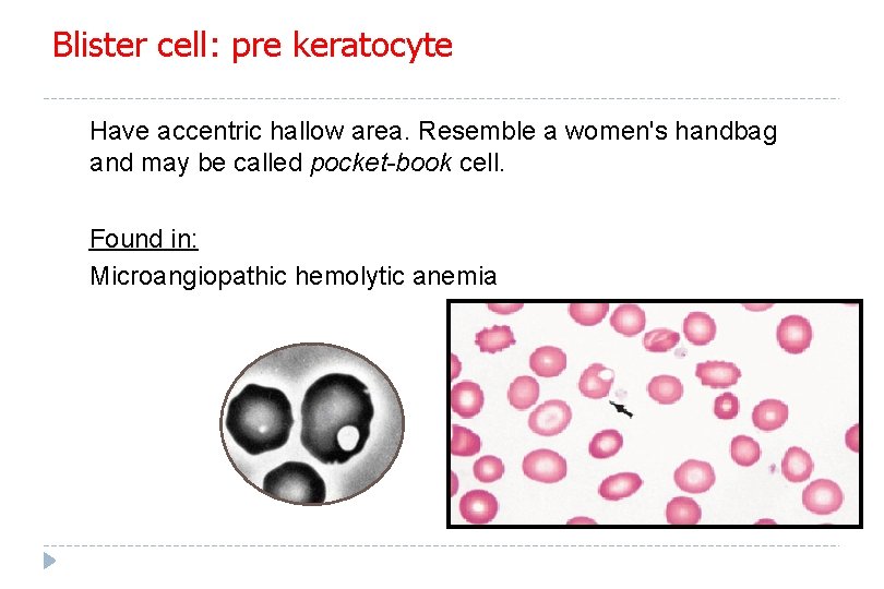 Blister cell: pre keratocyte Have accentric hallow area. Resemble a women's handbag and may