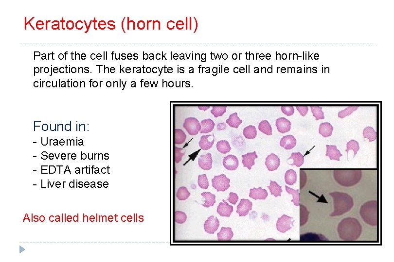 Keratocytes (horn cell) Part of the cell fuses back leaving two or three horn-like