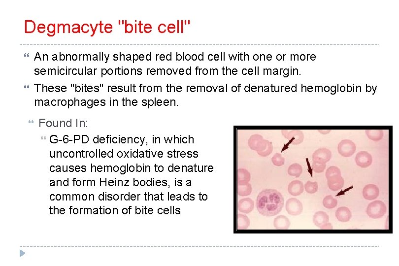 Degmacyte "bite cell" An abnormally shaped red blood cell with one or more semicircular