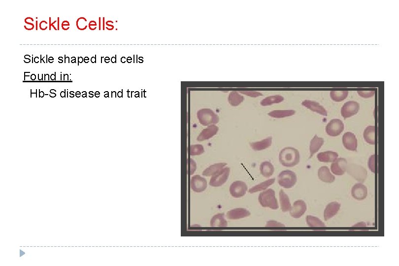 Sickle Cells: Sickle shaped red cells Found in: Hb-S disease and trait 