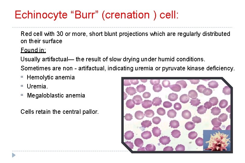 Echinocyte “Burr” (crenation ) cell: Red cell with 30 or more, short blunt projections