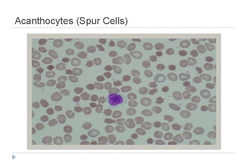 Acanthocytes (Spur Cells) 