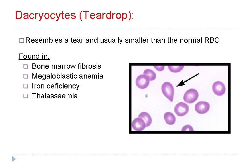 Dacryocytes (Teardrop): � Resembles a tear and usually smaller than the normal RBC. Found