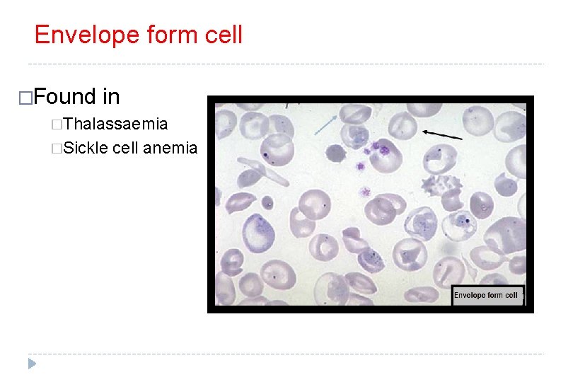 Envelope form cell �Found in �Thalassaemia �Sickle cell anemia 