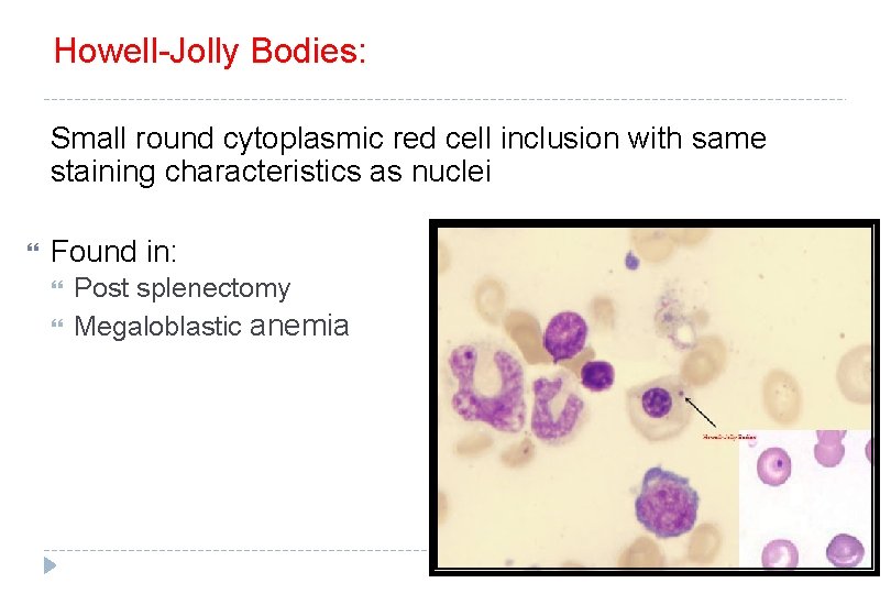 Howell-Jolly Bodies: Small round cytoplasmic red cell inclusion with same staining characteristics as nuclei