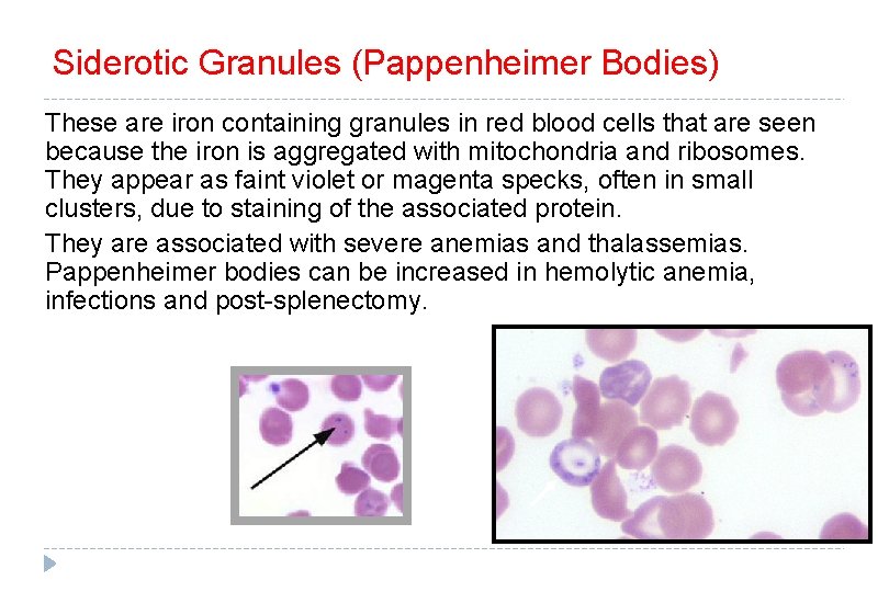 Siderotic Granules (Pappenheimer Bodies) These are iron containing granules in red blood cells that