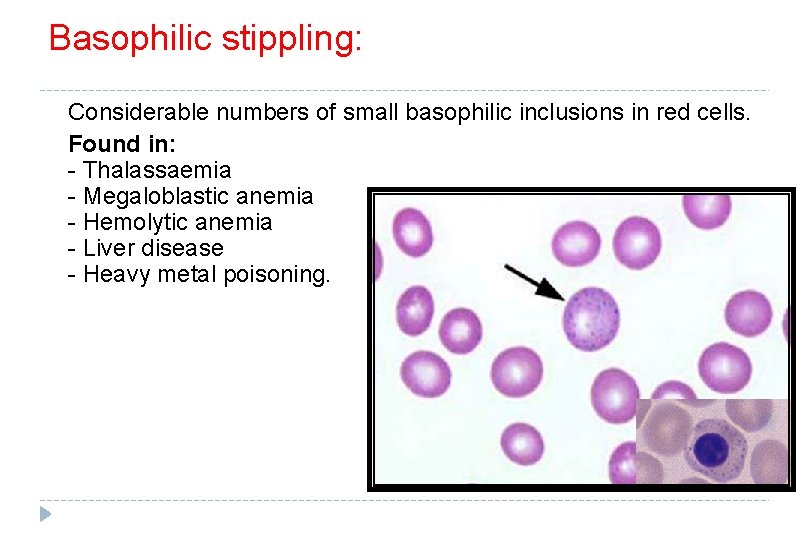 Basophilic stippling: Considerable numbers of small basophilic inclusions in red cells. Found in: -