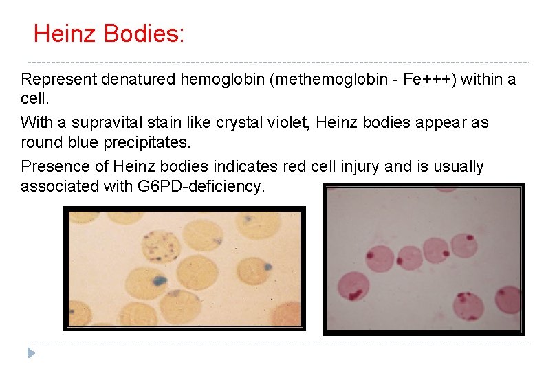 Heinz Bodies: Represent denatured hemoglobin (methemoglobin - Fe+++) within a cell. With a supravital