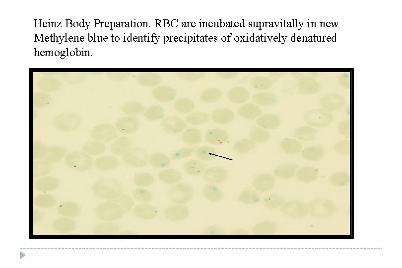 Heinz Body Preparation. RBC are incubated supravitally in new Methylene blue to identify precipitates