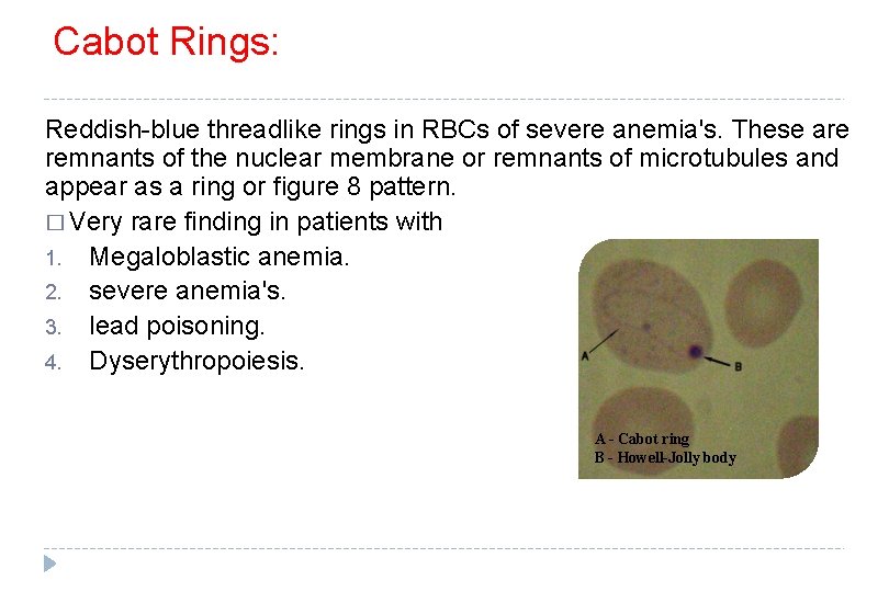 Cabot Rings: Reddish-blue threadlike rings in RBCs of severe anemia's. These are remnants of