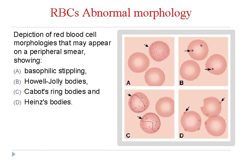 RBCs Abnormal morphology Depiction of red blood cell morphologies that may appear on a