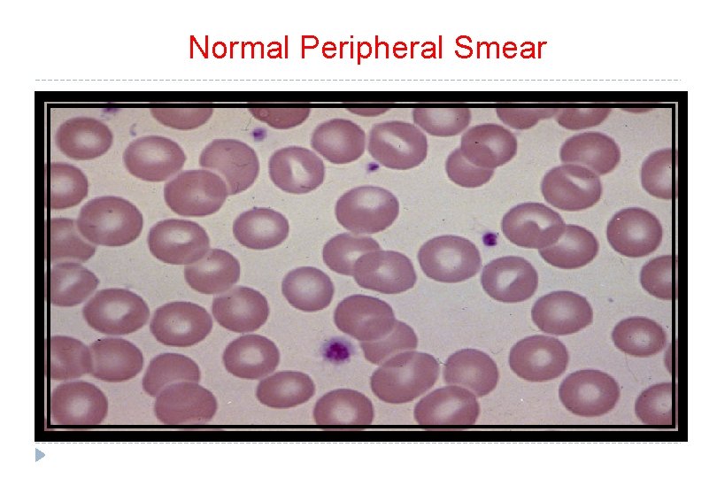 Normal Peripheral Smear 