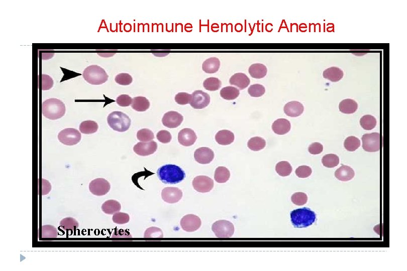 Autoimmune Hemolytic Anemia Spherocytes 