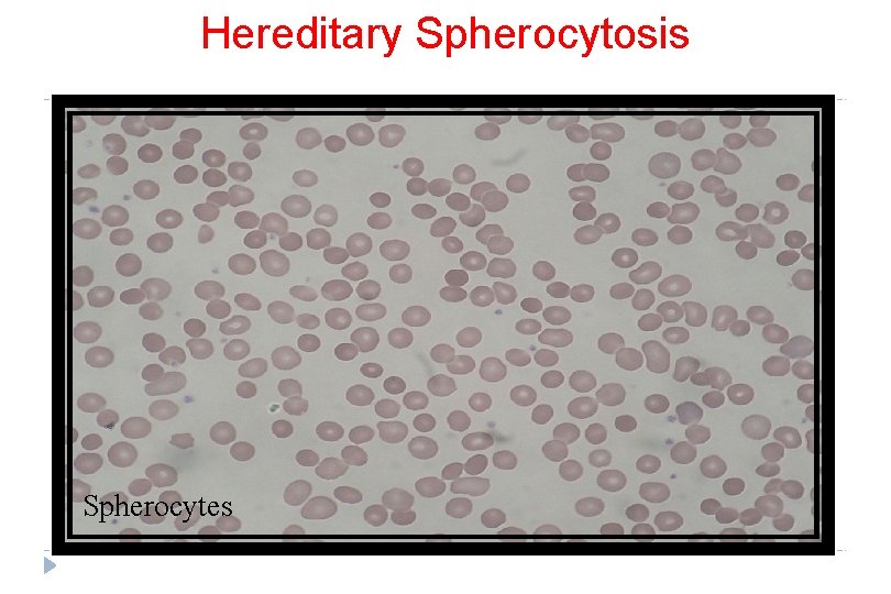 Hereditary Spherocytosis Spherocytes 