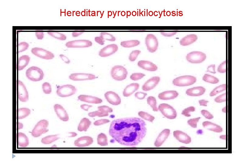 Hereditary pyropoikilocytosis 