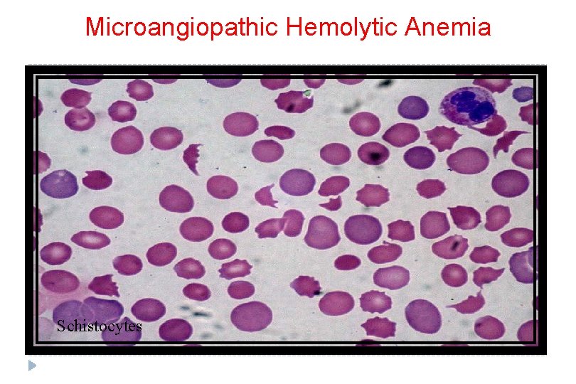 Microangiopathic Hemolytic Anemia Schistocytes 