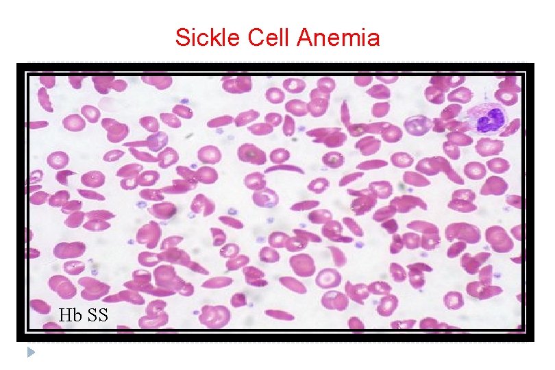 Sickle Cell Anemia Hb SS 