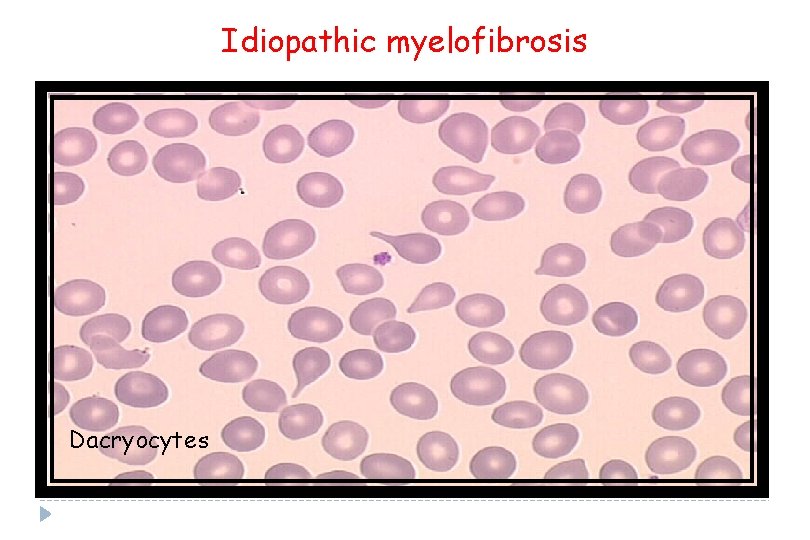 Idiopathic myelofibrosis Dacryocytes 
