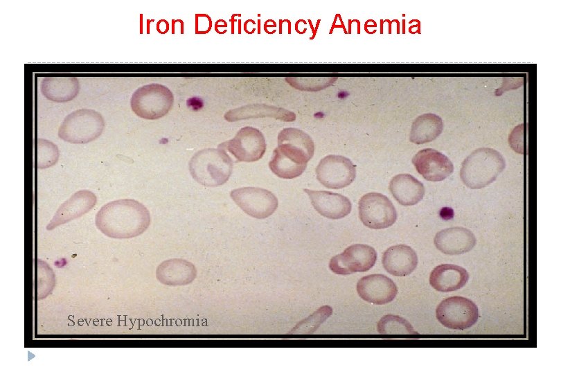 Iron Deficiency Anemia Severe Hypochromia 