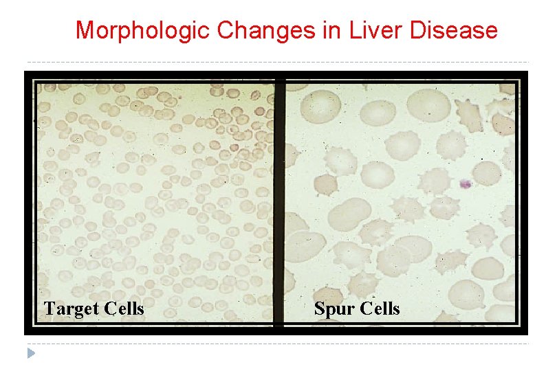Morphologic Changes in Liver Disease Target Cells Spur Cells 