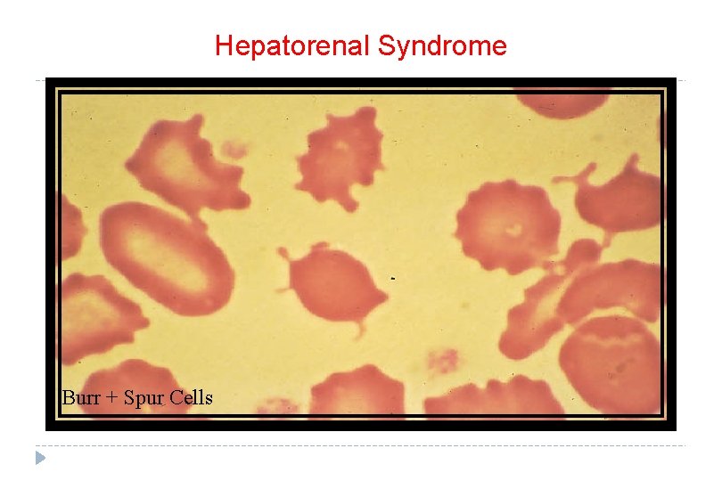 Hepatorenal Syndrome Burr + Spur Cells 