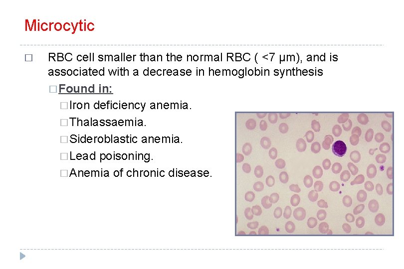 Microcytic � RBC cell smaller than the normal RBC ( <7 μm), and is