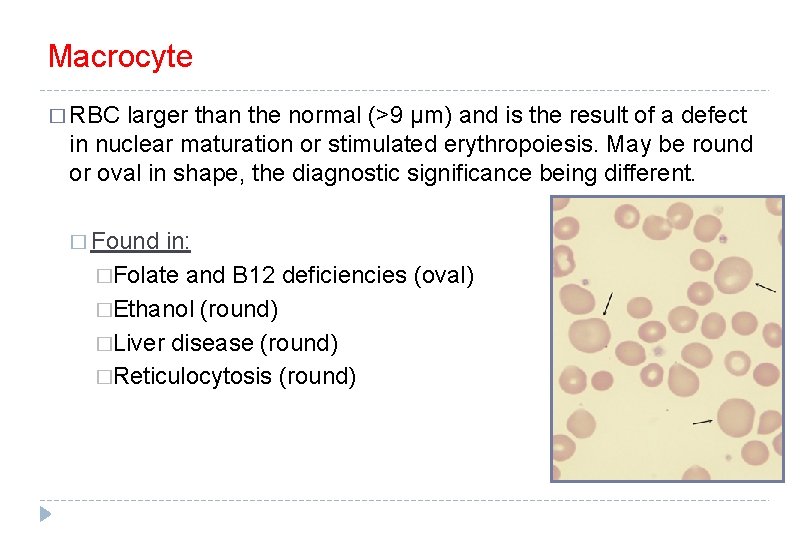 Macrocyte � RBC larger than the normal (>9 μm) and is the result of