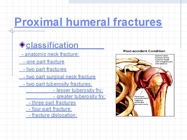 Proximal humeral fractures classification - anatomic neck fracture: - one part fracture - two