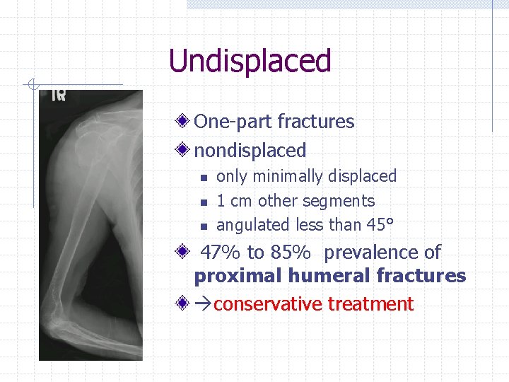 Undisplaced One-part fractures nondisplaced n n n only minimally displaced 1 cm other segments