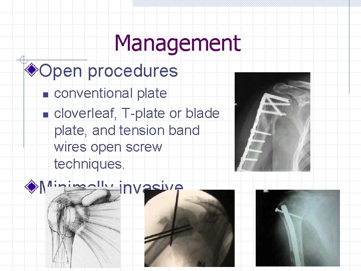 Management Open procedures n n conventional plate cloverleaf, T-plate or blade plate, and tension