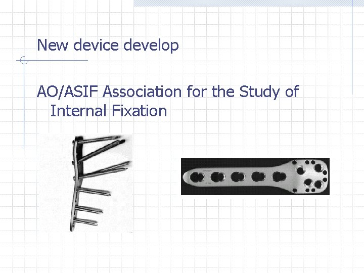 New device develop AO/ASIF Association for the Study of Internal Fixation 