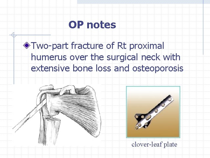 OP notes Two-part fracture of Rt proximal humerus over the surgical neck with extensive