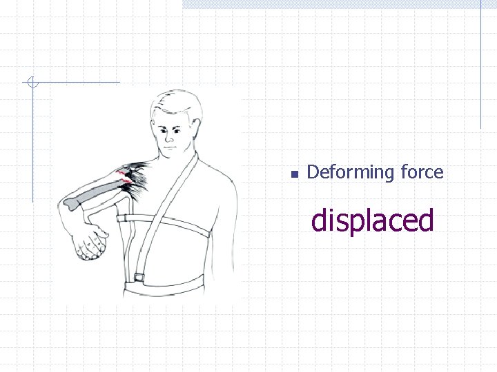 n Deforming force displaced 