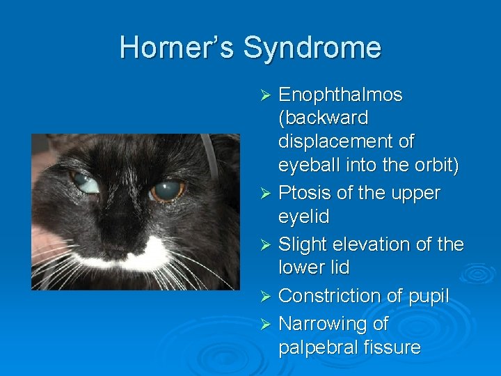 Horner’s Syndrome Enophthalmos (backward displacement of eyeball into the orbit) Ø Ptosis of the