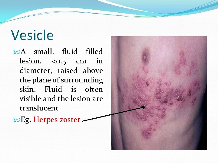 Vesicle A small, fluid filled lesion, <0. 5 cm in diameter, raised above the