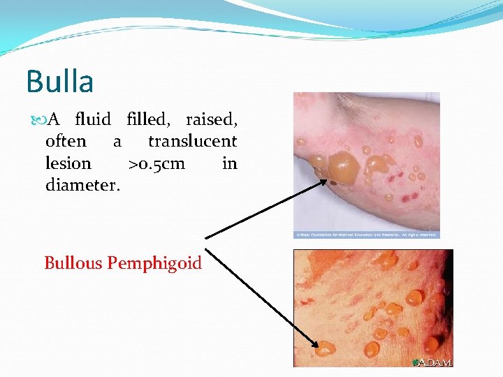 Bulla A fluid filled, raised, often a translucent lesion >0. 5 cm in diameter.